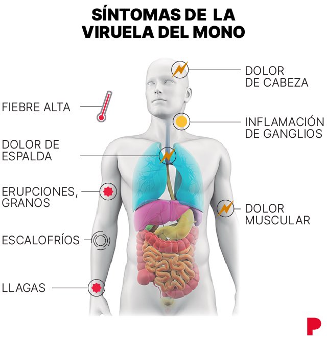 toxicologiamza's tweet photo. #ViruelaDelMono es una
enfermedad que se trasmite por contacto muy estrecho y suele producir fiebre, erupción cutánea e inflamación de los ganglios linfáticos, puede provocar variadas complicaciones médicas. Suele ser autolimitada, con síntomas que duran de 2 a 4 semanas. https://t.co/KDsMTGamQM