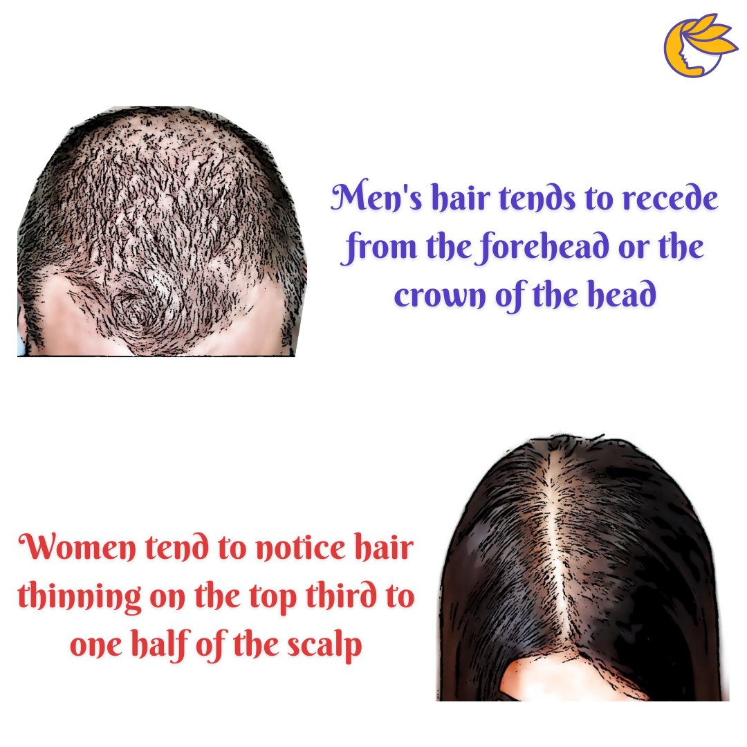 Do you want to know from which part of your head you're losing your hair?

#myhaircounts #myhairmatters #hairloss #hairdensity #dandruff #grayhair #menhairloss #femalehairloss #hairlosssolution #hairfall #hairfallcontrol #hairthinning #hairthinningsolution #hairlosshelp