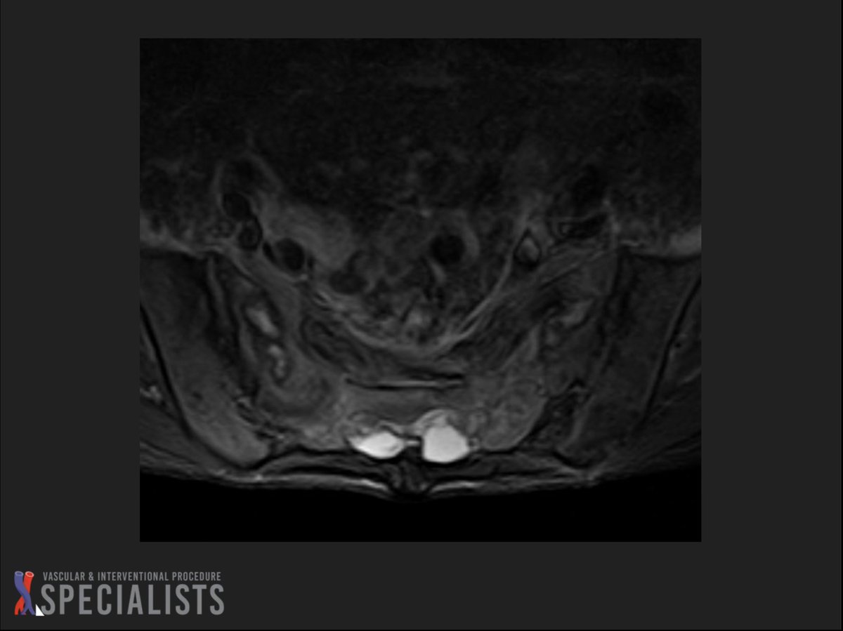 darthglader's tweet photo. 97 year old woman with low back pain one week after a fall. #sacroplasty @dougbeall @AlanAlperMD #MSKInterventions https://t.co/BRzmXj1wDe
