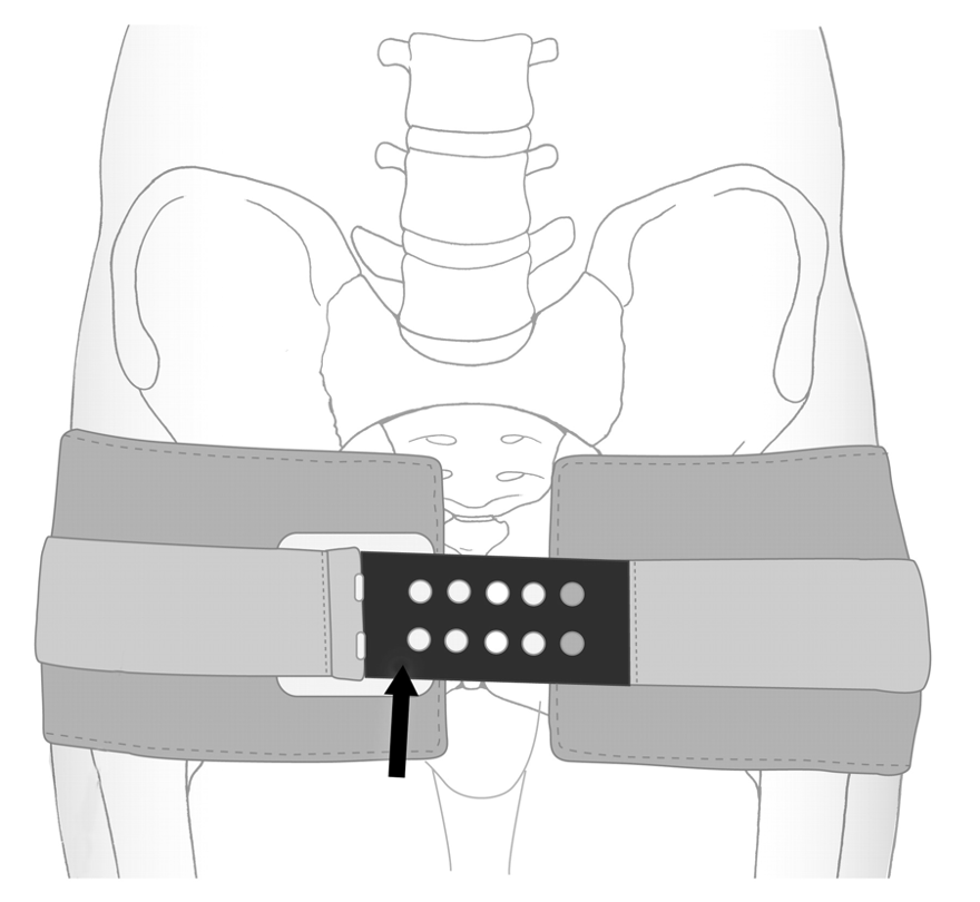 Seeing a lot of patients come in with unnecessary pelvic binders on.  A 🧵 on binders:

1) If the patient has ambulated at the scene, or the pelvic bones aren’t moving when you palpate them (i.e. the pelvis feels Orthopaedically stable), a binder isn't going to help.