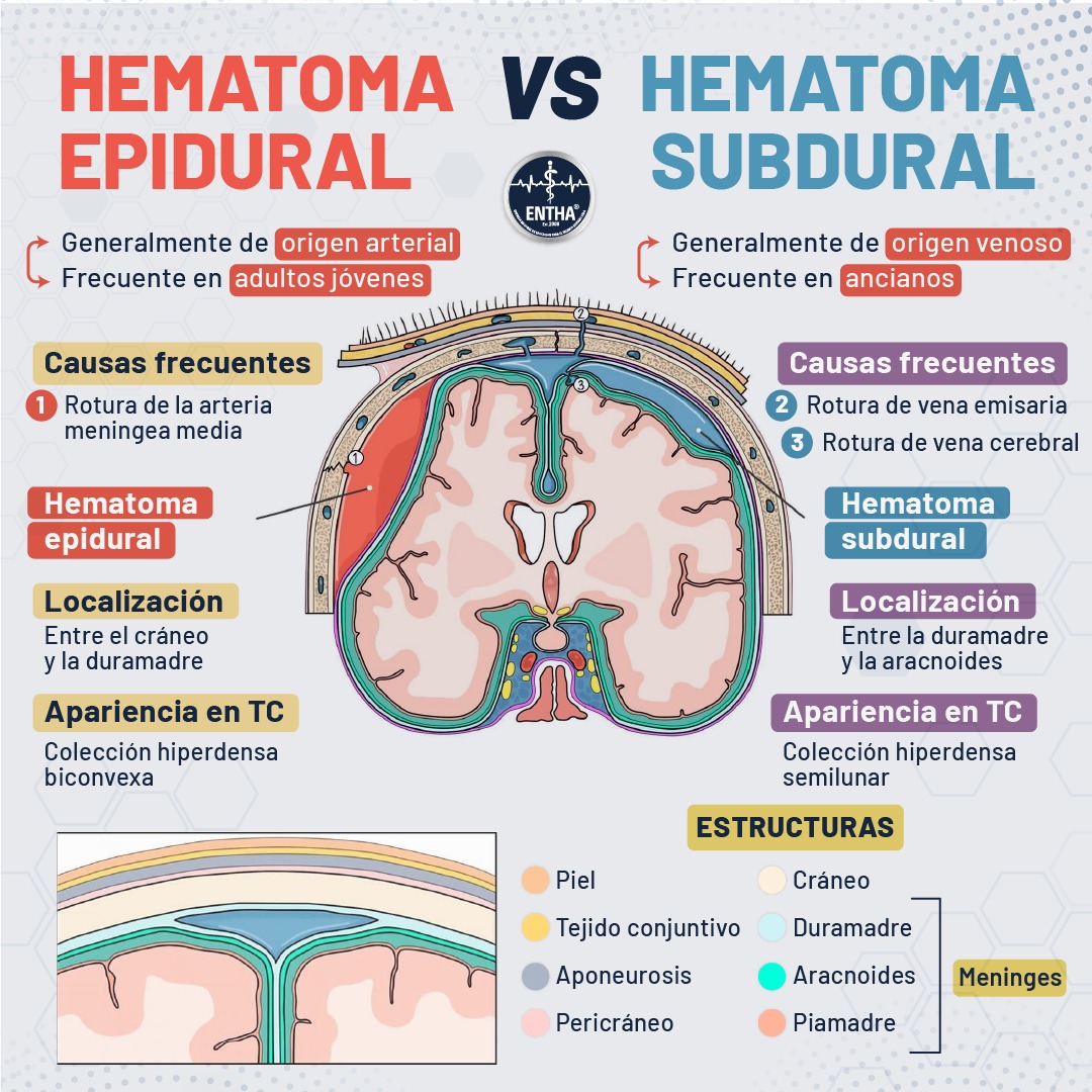 Hematoma Subdural Que Une Las Venas