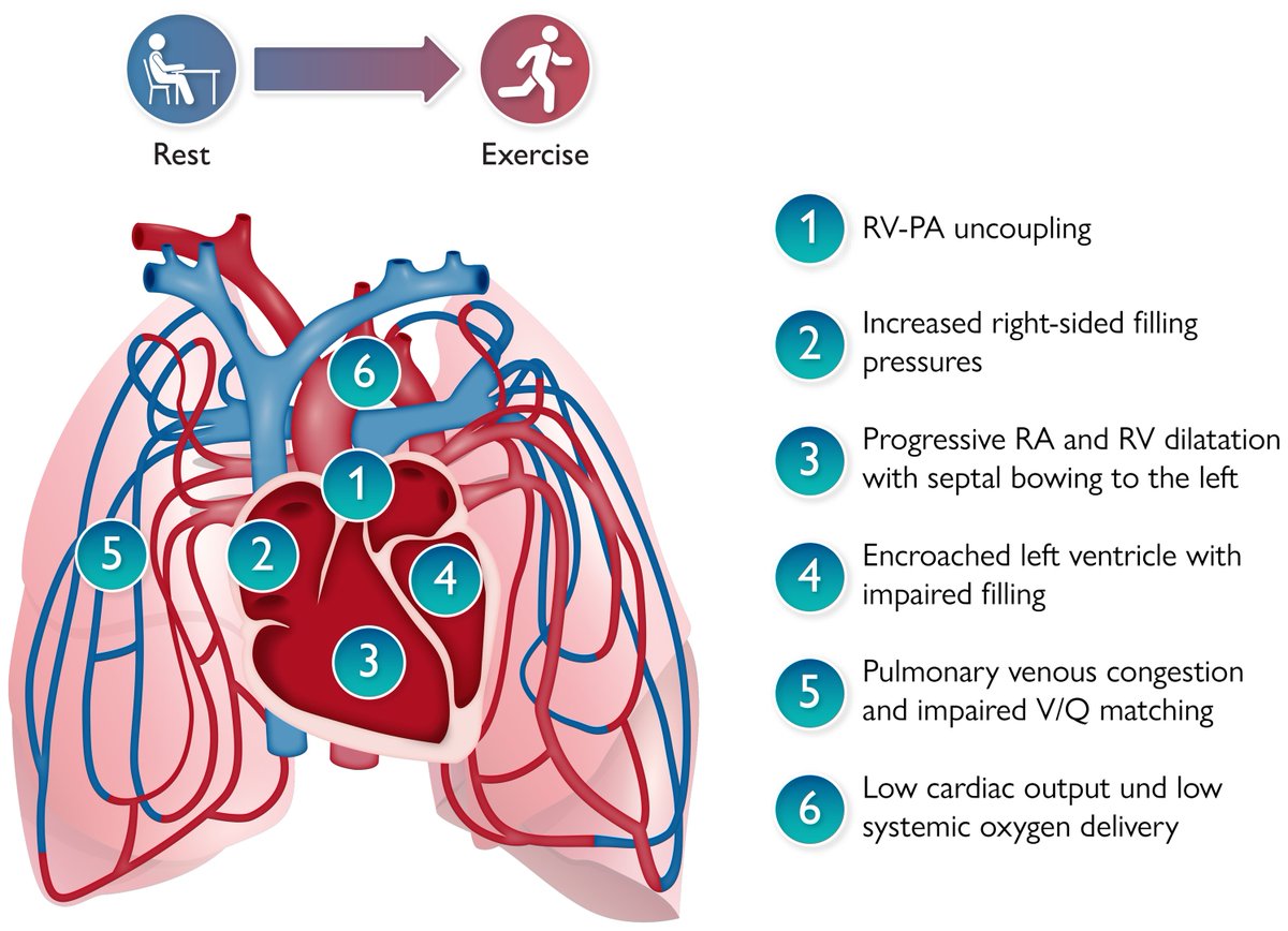 Was Paul Wood wrong about pre-capillary pulmonary hypertension protecting against pulmonary congestion in left heart disease? academic.oup.com/eurheartj/adva… #PH #exercise #LHD #cardiacoutput #congestion @escardio @ESC_Journals