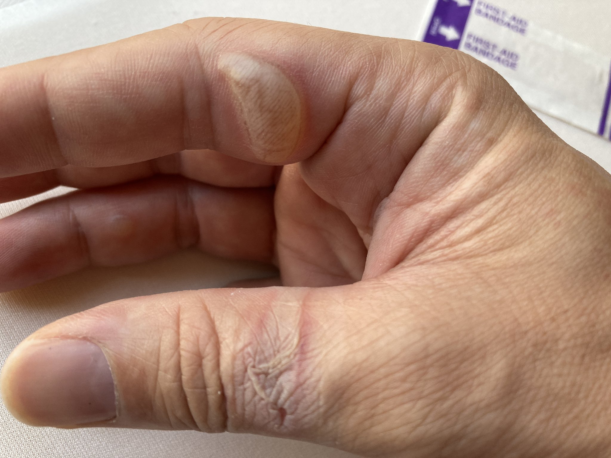 تويتر デゴチ Mft22 B 01 06ブース على تويتر 火傷から3日後 水ぶくれの方は昨日の夜感じていた圧迫感と微妙な違和感は無くなり安定 相変わらず猫の肉球のように柔らかくぷにぷにしている 潰した方も特に痛みも無く普通に治癒しているっぽい感じ 傷口を保護