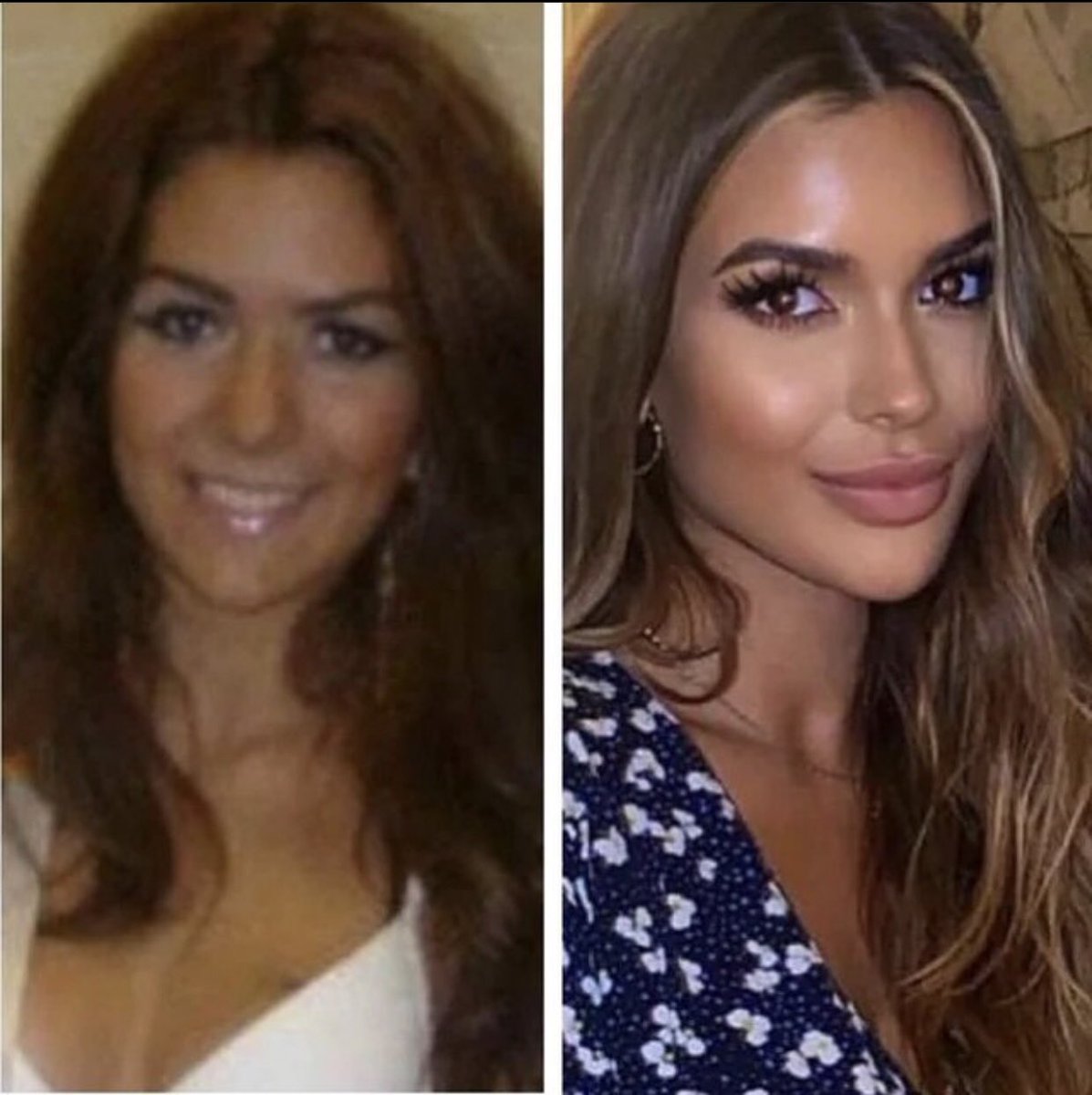 The power of a great doctor!

Love Island’s Ekin-Su has completely transformed since her younger days, but she’s managed to retain a realistic appearance with a natural finish.

That top lip especially makes such a difference without looking over-full.
#loveisland #ekinsu #doctor