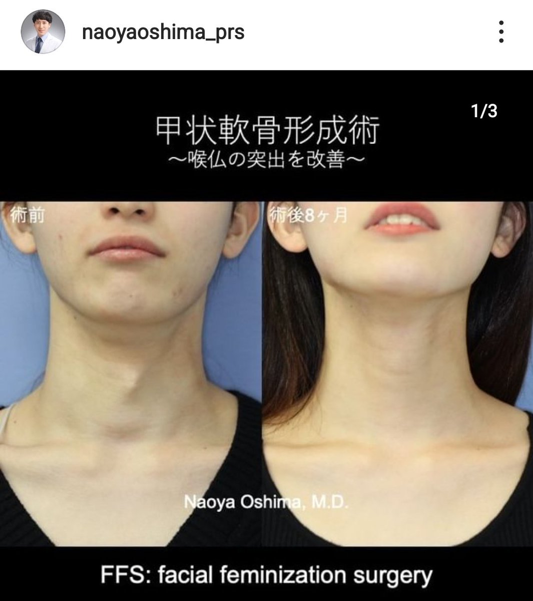 喉仏 女性