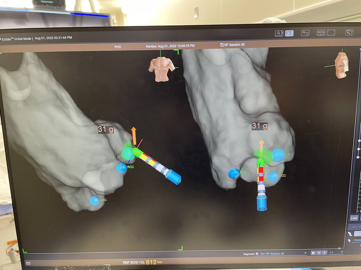 tayamagu's tweet image. First LVOT PVC case using TactiFlex. Transaortic antegrade approach to RCC/LCC transition zone eliminated the PVCs as the Vector shows. Amazing RF catheter! #TactiFlex #EnSiteX #SagaUniversity