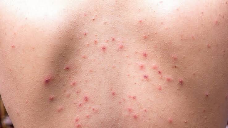 treatment untuk menghilangkan jerawat punggung

a thread