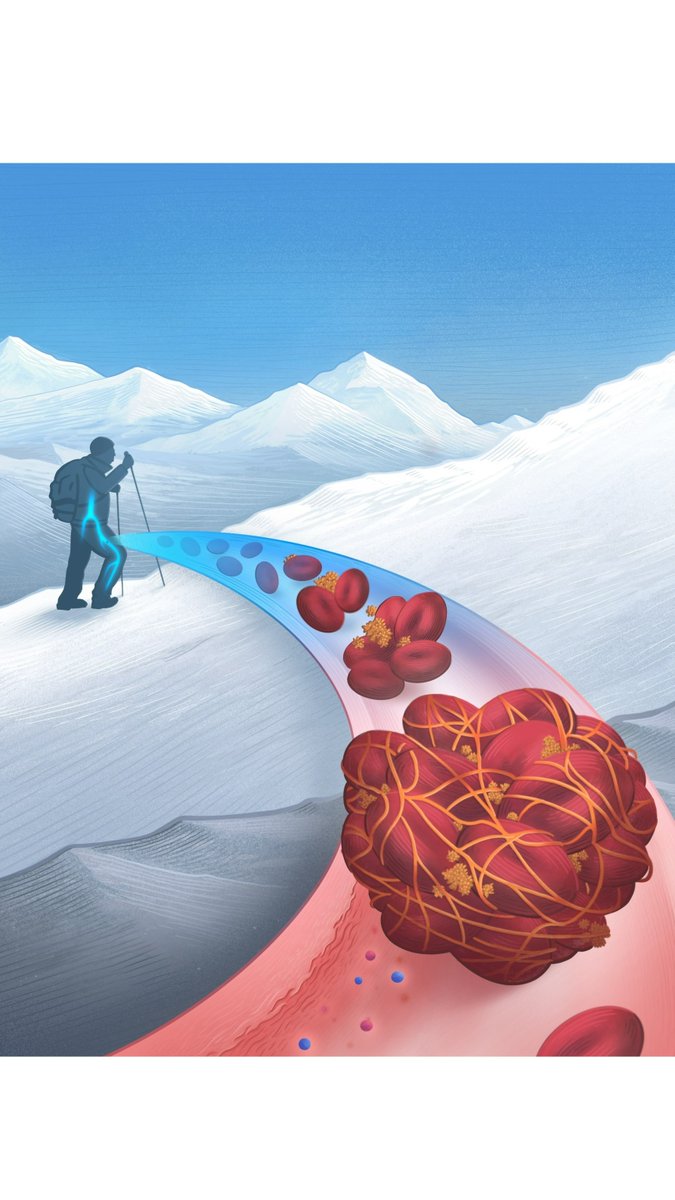 The Lancet Reg Health-Southeast Asia (@lancetrh_seasia) on Twitter photo Incidence of vascular thrombosis in healthy subjects at high altitude was higher than that at near sea-level. Associated with #Inflammation endothelial dysfunction, a prothrombotic state & dampened fibrinolysis
thelancet.com/journals/lanse…
<a href="/DrVeluNair2/">Lt Gen (Dr) Velu Nair</a>
#IndianArmy #India #Soldiers Incidence of vascular thrombosis in healthy subjects at high altitude was higher than that at near sea-level. Associated with #Inflammation endothelial dysfunction, a prothrombotic state & dampened fibrinolysis
thelancet.com/journals/lanse…
<a href="/DrVeluNair2/">Lt Gen (Dr) Velu Nair</a>
#IndianArmy #India #Soldiers