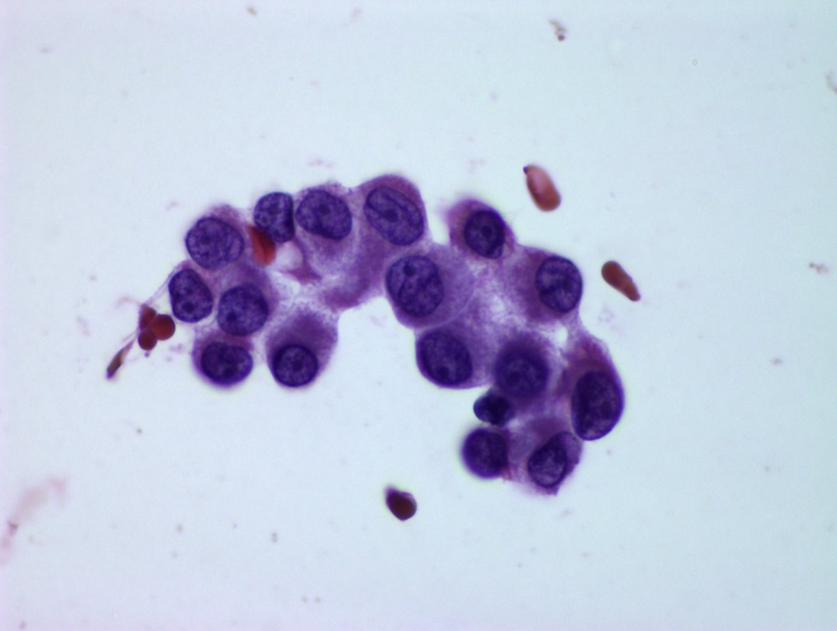 nucleololailo's tweet photo. ..these are not the cells from the previous case I shared...promise!
..do you dare to launch a diagnosis with these 4 images?
It's a lung nodule TB-FNA #cytopath #EBUS https://t.co/UgarDbSt4P