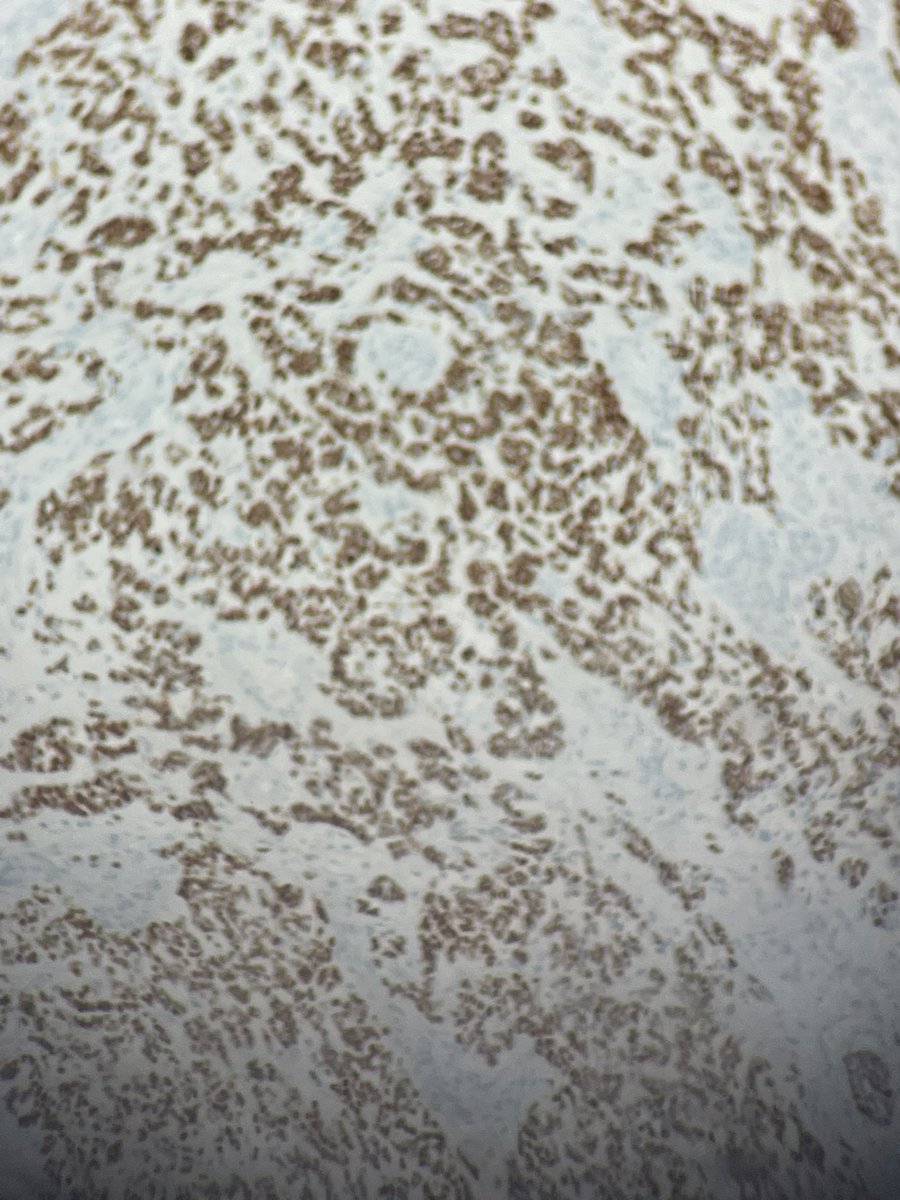 M7ammed_Subait's tweet photo. 73 years old man, right frontal tumor with history of colic ADK and mantle cell lymphoma, what’s your Diagnosis and IHC ?!#neurotwitter #PathTwitter #pathology #neurpath #pathology https://t.co/0DSJZiVWyw