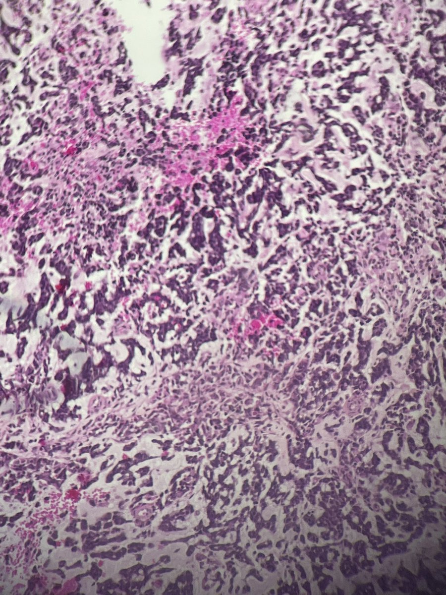M7ammed_Subait's tweet photo. 73 years old man, right frontal tumor with history of colic ADK and mantle cell lymphoma, what’s your Diagnosis and IHC ?!#neurotwitter #PathTwitter #pathology #neurpath #pathology https://t.co/0DSJZiVWyw