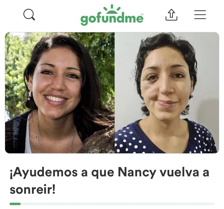 TrujiYo's tweet photo. La vida puede cambiarte de un momento a otro: les presento a Nancy.

33 años. Joven. Radiante. Profesional. Hasta que un cáncer, de un tipo especialmente agresivo, cambió los planes que tenía para su vida.

Esta es su historia. Colaboremos con ella:👇

https://t.co/yfwfAZZcqd https://t.co/mecQEJVhYt