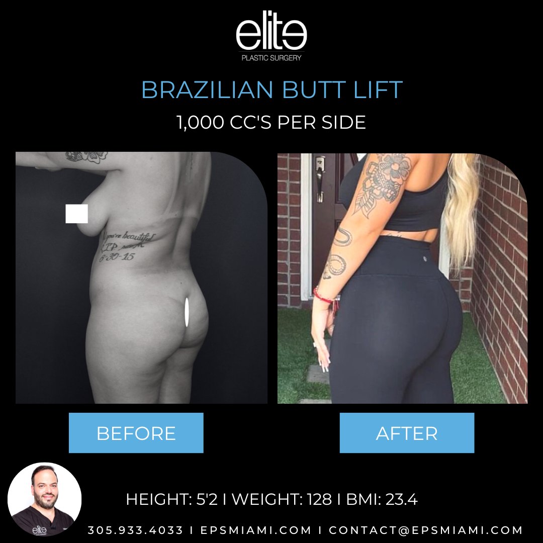 EPSMiami's tweet photo. Enhancing the booty is what Dr. Salama does best. Whether the results you want are dramatic or subtle, get yourself a #brazilianbuttliftβ by Dr. Salama.
βββπ»β https://t.co/zRKQqiJHrF
βββπβ 305.933.4033
βββπ§β contact@epsmiami.com
ββ#bbl #buttaugmentation #plasticsurgery #miami https://t.co/twxXnGnmBc