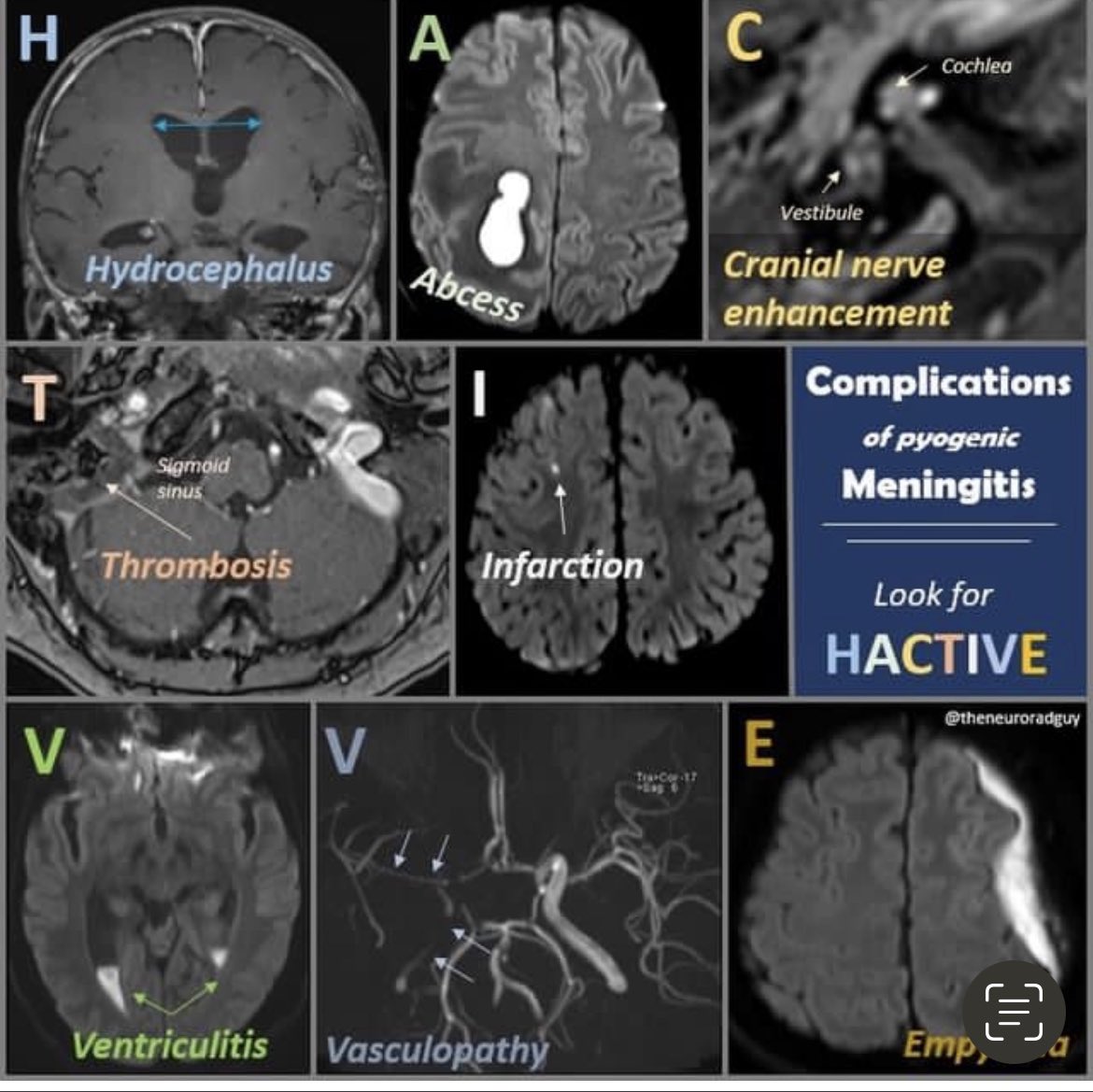 OGdukeneurosurg's tweet photo. A primer on complications of Meningitis and gross brain specimen. https://t.co/ZAx6IjHBaM