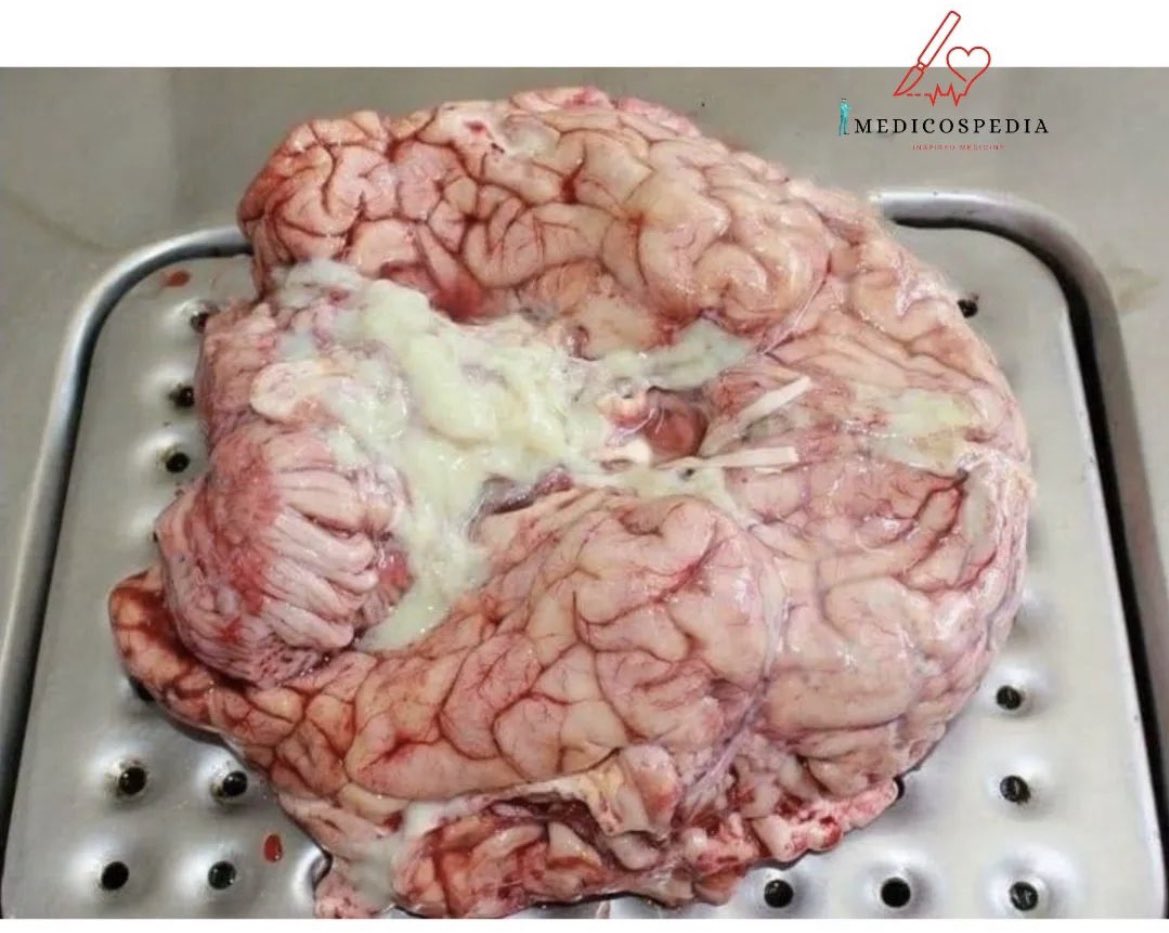 OGdukeneurosurg's tweet photo. A primer on complications of Meningitis and gross brain specimen. https://t.co/ZAx6IjHBaM