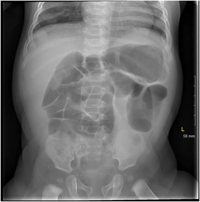 JACEPOpen's tweet photo. New in JACEP Open from @Swydini: Intussusception in the setting of severe acute respiratory syndrome coronavirus 2 infection following rotavirus vaccination.
#FOAM, #COVID19, #Intussusception, #Rotavirus
https://t.co/OvI5NAC7ZU
@EmergencyDocs @ACEPNow @WileyHealth https://t.co/DNeHbutVUx
