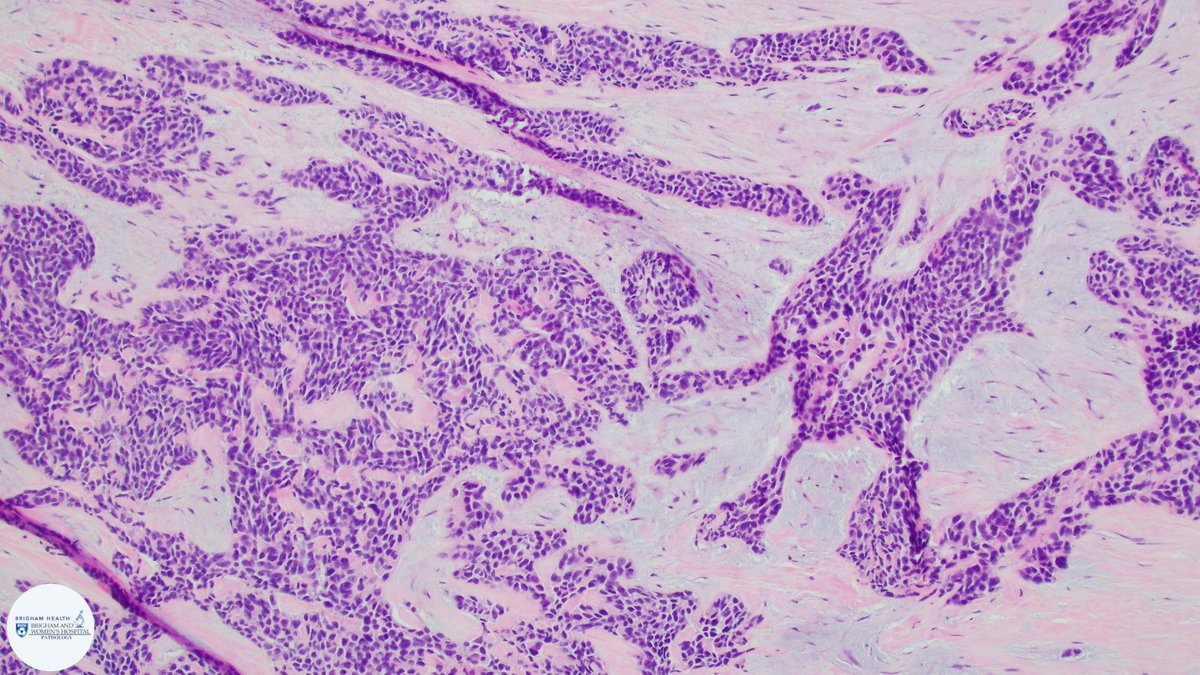 BWHPath's tweet photo. A young patient presents with a pelvic mass. H&amp;E shows small monomorphic cells in a nested pattern with a prominent stromal response. What is your differential? What studies would you consider? #BWHPathCotW  #BWHGynPathSummer #pathology https://t.co/rdd09iM2Ar
