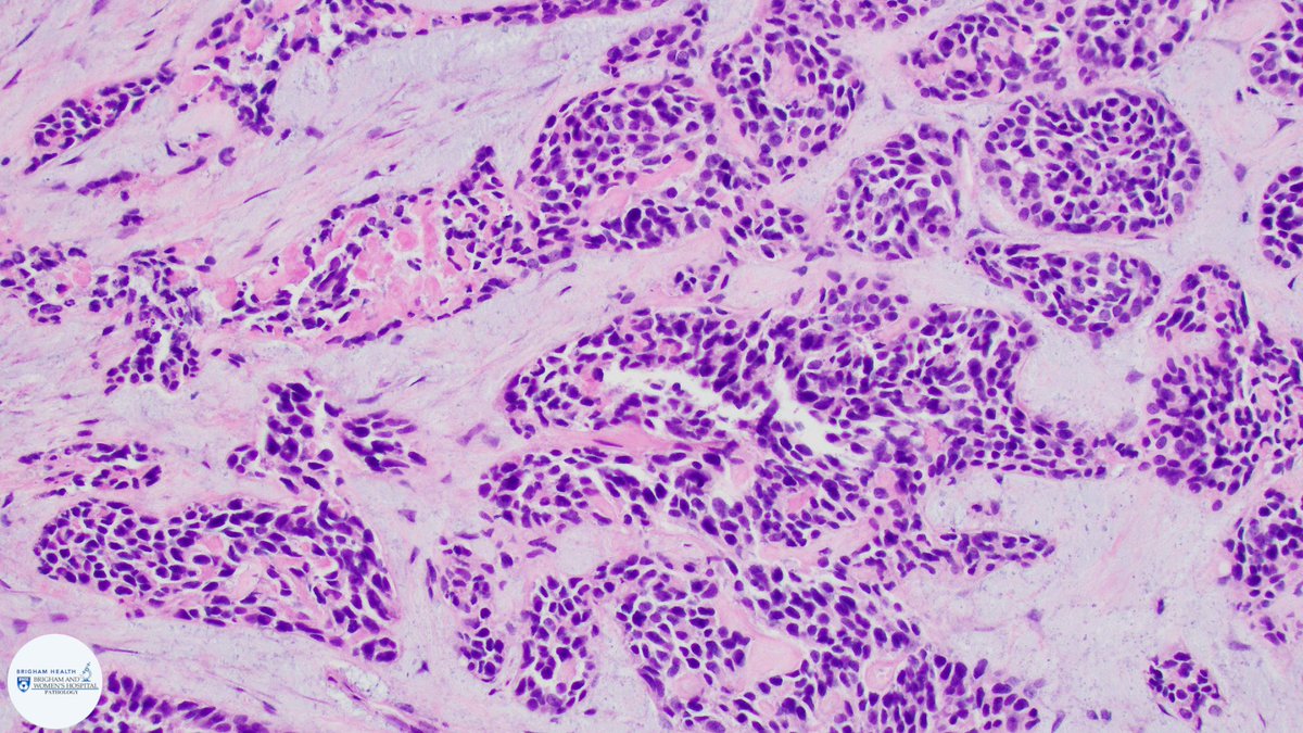 BWHPath's tweet photo. A young patient presents with a pelvic mass. H&amp;E shows small monomorphic cells in a nested pattern with a prominent stromal response. What is your differential? What studies would you consider? #BWHPathCotW  #BWHGynPathSummer #pathology https://t.co/rdd09iM2Ar