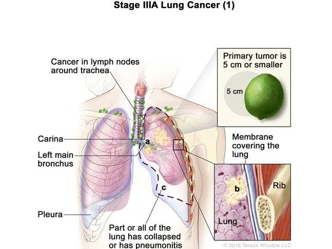 The #immunotherapy drug atezolizumab (Tecentriq) is an additional, or adjuvant, treatment after surgery and chemotherapy for some patients with lung cancer. #LCAM #WorldLungCancerDay cancer.gov/news-events/ca…