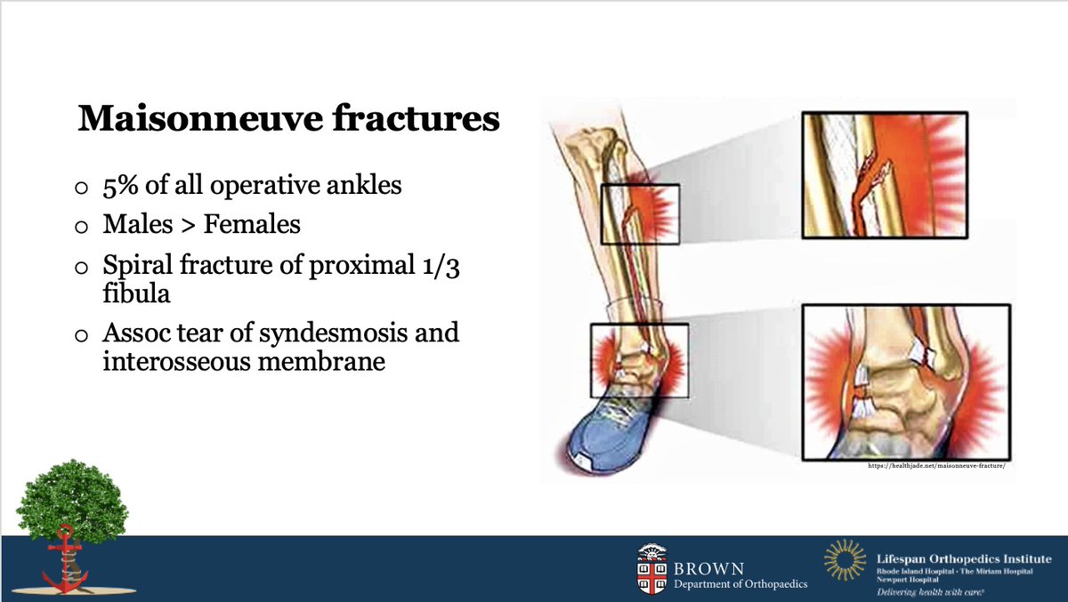I presented on Maisonneuve fractures to my trauma team last week, and I can say without hesitation that the majority of my prep was simply spent in practicing how to pronounce "Maisonneuve".