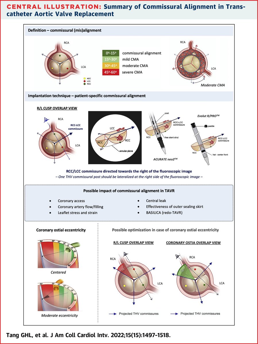 New issue of #JACCINT is out!

State-of-the-art review by the ALIGN-TAVR consortium: In-depth insight of commissural alignment in #TAVR, including rationale, standardized definitions, technical steps, outcomes, &amp; future directions ➡️ bit.ly/3SuMtQH

#vhdAS #CardioTwitter