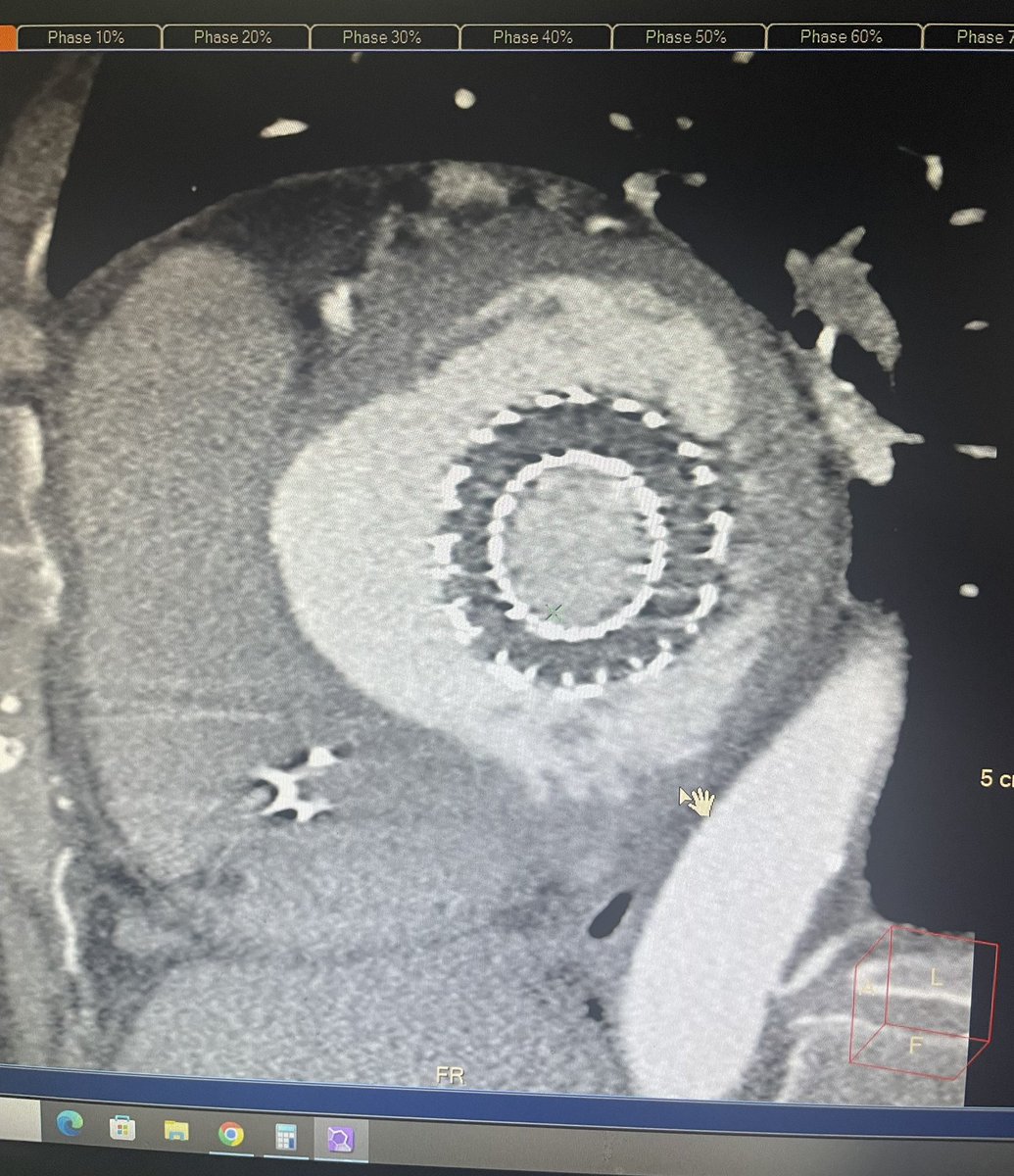 S/P TMVR 4 years. 
What’s your diagnosis ?
#cardiaccta 
#TMVR
#MountSinaiHeart
@SinaiCards @IcahnMountSinai @MSHCardsCT @MountSinaiHeart @MSadvancedheart @MountSinaiNYC @DOMSinaiNYC @MSMCardsFellows