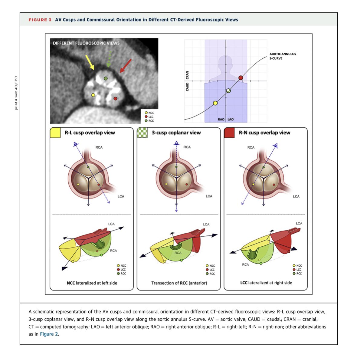 Dr. Gilbert Tang (@gilberttangmd) on Twitter photo Just out! <a href="/JACCJournals/">JACC Journals</a> #JACCINT SOTA review from our ALIGN-TAVR group on #TAVR commissural alignment. From 2/2021 virtual mtg to a paper! Congrats <a href="/ignamatsant/">Ignacio J. Amat</a> <a href="/AlfredoRedondoD/">Alfredo Redondo</a> OleDeBaker LarsSondergaard <a href="/G_Tarantini01/">Giuseppe_Tarantini</a> SyedZaid <a href="/barbanti_marco/">Marco Barbanti</a> <a href="/costagiuliano90/">Giuliano Costa</a> <a href="/MAvvedimento/">Marisa Avvedimento</a> Just out! <a href="/JACCJournals/">JACC Journals</a> #JACCINT SOTA review from our ALIGN-TAVR group on #TAVR commissural alignment. From 2/2021 virtual mtg to a paper! Congrats <a href="/ignamatsant/">Ignacio J. Amat</a> <a href="/AlfredoRedondoD/">Alfredo Redondo</a> OleDeBaker LarsSondergaard <a href="/G_Tarantini01/">Giuseppe_Tarantini</a> SyedZaid <a href="/barbanti_marco/">Marco Barbanti</a> <a href="/costagiuliano90/">Giuliano Costa</a> <a href="/MAvvedimento/">Marisa Avvedimento</a>