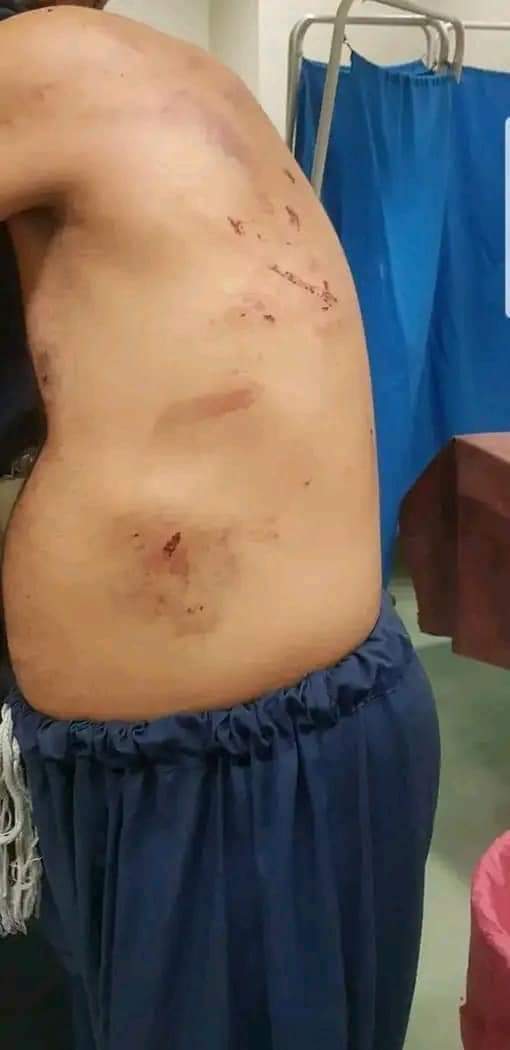 AzharRasheed_'s tweet photo. پاکستانی مقبوضہ کشمیرمیں بجلی بلات میں ظالمانہ ٹیکسزکےخلاف احتجاج کرنےوالےنوجوانوں کوقیدخانوں میں بدترین تشددکانشانہ بنایاجا رہا ہےانکے جسم کاٹ کرزخموں پر نمک پاشی کی جارہی ہے۔انسانی حقوق کی بدترین خلاف ورزیاں عروج پرہیں مگرانسانی حقوق کےعلمبردار خاموش!
#AJKRightsMovement https://t.co/16s9yYGnBF