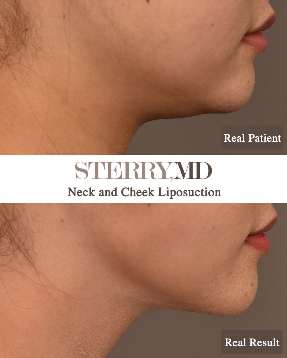 3 months post-op! Neck and Cheek Liposuction🔥

What an amazing transformation for my beautiful patient! We are both pleased with her outcome 😎

What do you think? 

#chinlipo #chinliposuction #liposuctionsurgery