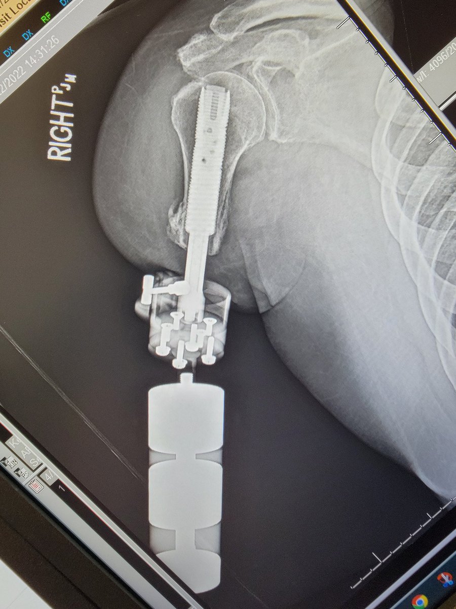 **With permission** Clinic on day 1 with @LimbDeformity traveling fellows. Great patient with humerus OI showing off overhead activity! #osseointegration @CLTOsseointegr1 @DrMarecek