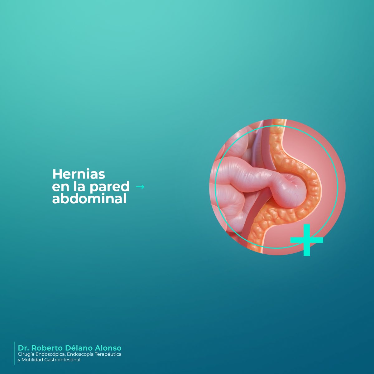 roberto_delano's tweet photo. La hernia en la pared abdominal es una protrusión del contenido abdominal a través de una zona adquirida o congénita de debilidad o defecto de la pared.
Tiene tratamiento quirúrgico. https://t.co/dqXYSEo2S5