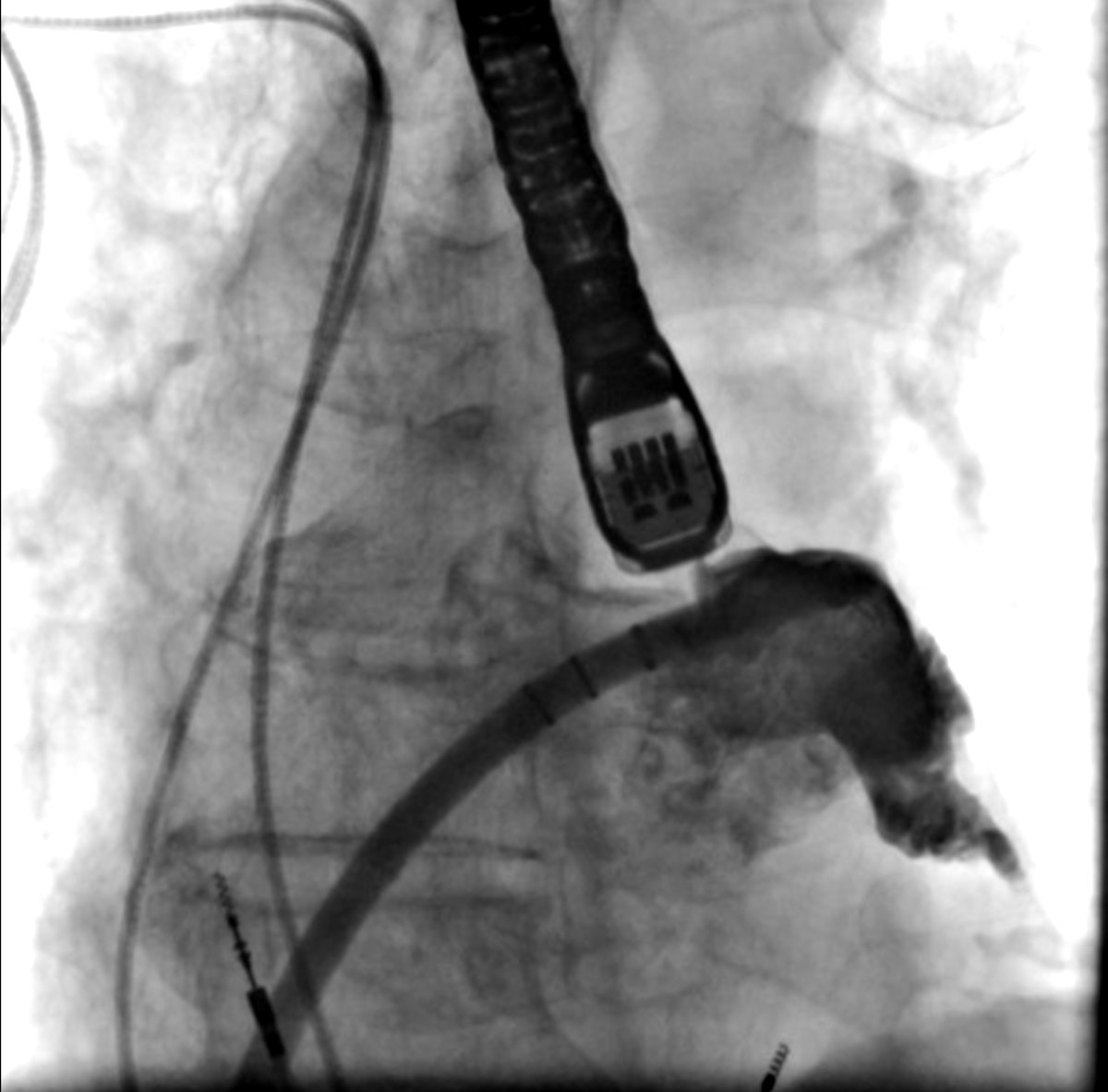 EduardoAArias1's tweet photo. Successful implant of a 27mm Watchman FLX in a patient with AF + stroke despite OAC. Grateful for being part of this cutting edge Structural Intervention team. Juan Pablo Sandoval Jones @hzanellamd @Tiger1407Arias @felixdamasds @samiereyes #LAAO #Mexicocity https://t.co/s0mvUmYDiU
