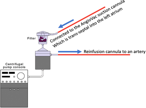 Transcatheter vacuum-assisted left-sided mass extraction with the AngioVac system
onlinelibrary.wiley.com/doi/full/10.10…
<a href="/ccijournal/">CCIjournal</a>