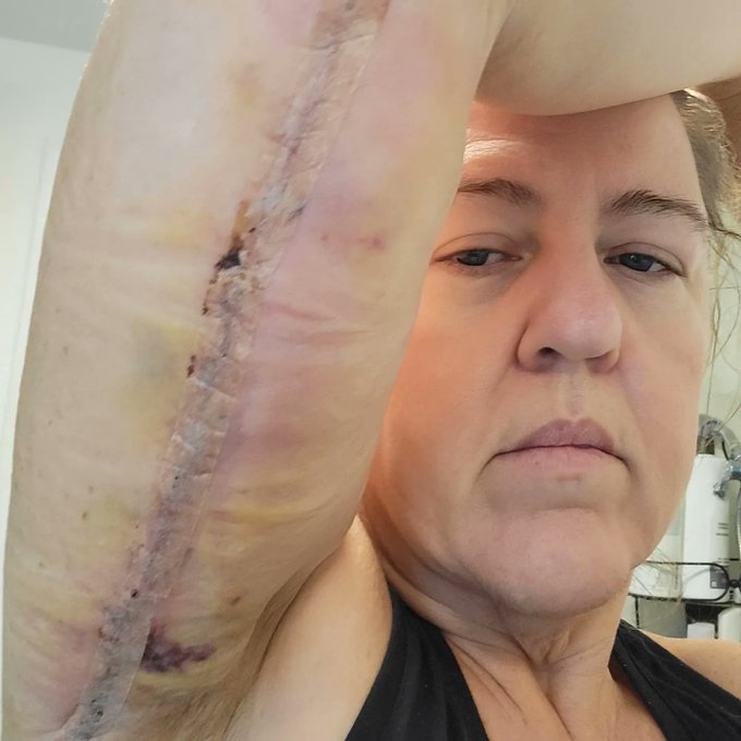 Lot of healing to do. Long way to go https://t.co/SRQR5znwOQ<a href="/tag/weightloss"class="tags"><span>#weightloss</span></a><a href="/tag/weightlosstransformation"class="tags"><span>#weightlosstransformation</span></a><a href="/tag/dontownrightstothismusic"class="tags"><span>#dontownrightstothismusic</span></a>