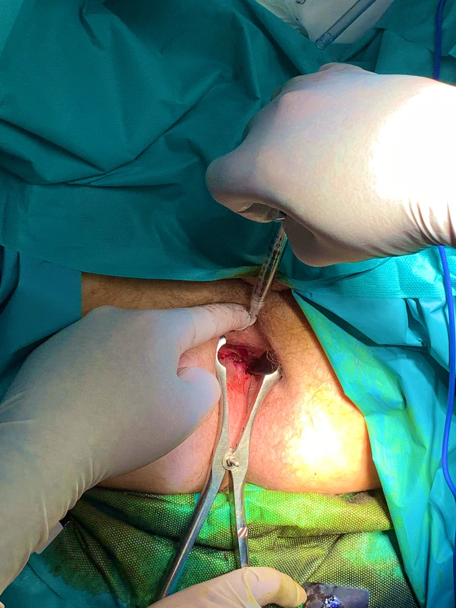 equipodrduran's tweet photo. El retraso en el diagnostico y tratamiento por miedo al quirófano en la patología proctológica es una realidad. Actualmente disponemos de procedimientos alternativos a las técnicas clásicas, menos agresivos y dolorosos, como la toxina botulínica en la fisura anal. #fisuraanal https://t.co/SEVaU1yQAN