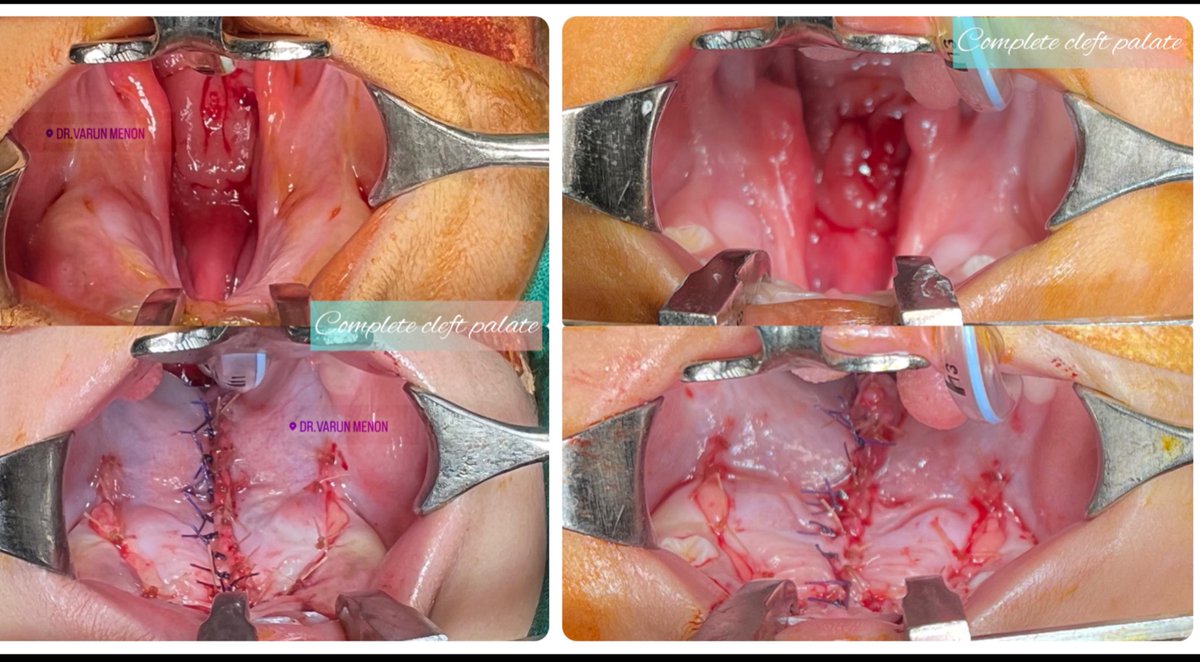 varunmp's tweet photo. It’s Yet another Day of back to back Palatoplasty -
Usually Cleft palate repair is done close to 1year of Age
Today’s patients were both close to two years of age
#Very long soft palate
#Good muscle bulk
#Pierre Robin sequence
#Micrognathia
#maxillofacialsurgery https://t.co/3svU5kqk4W