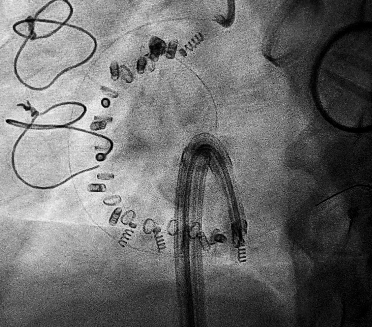 ramirotrillo's tweet photo. First CARDIOBAND procedure in @HCASantiago @cardiologiaCHUS. Great result!! Thanks to @EdwardsLifesci team for the support. @shci_sec @secardiologia @PCRonline @belcid7 @birihh @xoansanmartin @MonzonisAmparo @VioletaGSalvado @pablompereiro @fixmg @JoseJuanatey soniabeiras https://t.co/aA6BliVm58