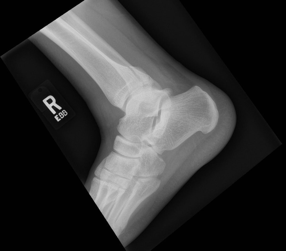 orthoEMpearls's tweet image. Patient presents to ED with posterior ankle pain, swelling, and ecchymosis a fall down the stairs.  #FOAMed #FOAMrad #EMTwitter #EmergencyMedicine 

Find out full details tomorrow by signing up for our email list!

Case and image by @justinekomd