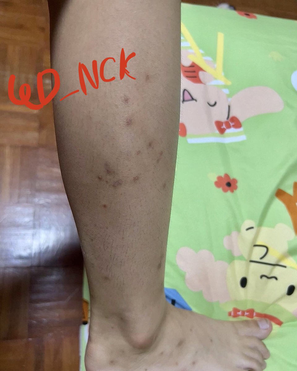 QD_NCK's tweet photo. ย้ำ! โนสปอน เห็นกระแสดีมาก เลยลองซะ
คือเราโดนหมัดแมวกัดปลายเมษาที่ผ่านมา รอยดำเต็มขา ไม่จางเลย😭 ทั้งทาโลชั่น ขัดขา ทาเจลรอยแผล
และลองใช้ Dr.Pong 28D whitening drone ที่กระแสแรงมาก ผลลับที่ได้จากการใช้มา 14 วัน! แก จึ้งมากกก มันจางลงจริงๆๆ ดีใจจนน้ำตาจะไหล😭💕 จะอวสานขาลายสักที https://t.co/f1PzHHoGyh