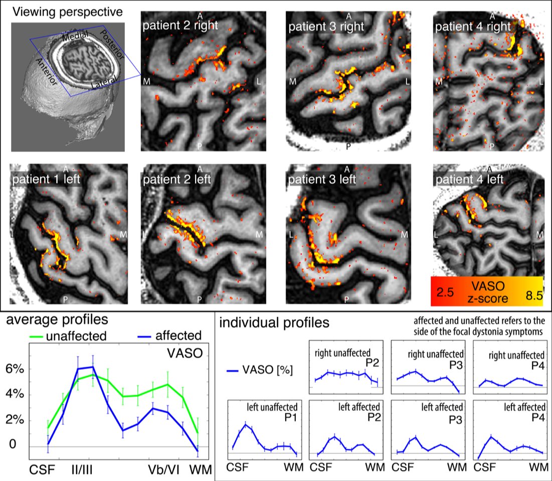 layerfMRI (@layerfmri) on Twitter photo New preprint on layer-dependent fMRI signal differences in focal hand dystonia patients.
A brief research report from an inter-disciplinary team of authors.
With <a href="/SilvinaHorovitz/">Silvina Horovitz</a>, <a href="/MarkHallett007/">Mark Hallett</a>, <a href="/ofgulban/">Faruk Gulban</a>, and <a href="/PKassavetis/">Panagiotis Kassavetis, MD, PhD</a>
doi.org/10.1101/2022.0… New preprint on layer-dependent fMRI signal differences in focal hand dystonia patients.
A brief research report from an inter-disciplinary team of authors.
With <a href="/SilvinaHorovitz/">Silvina Horovitz</a>, <a href="/MarkHallett007/">Mark Hallett</a>, <a href="/ofgulban/">Faruk Gulban</a>, and <a href="/PKassavetis/">Panagiotis Kassavetis, MD, PhD</a>
doi.org/10.1101/2022.0…