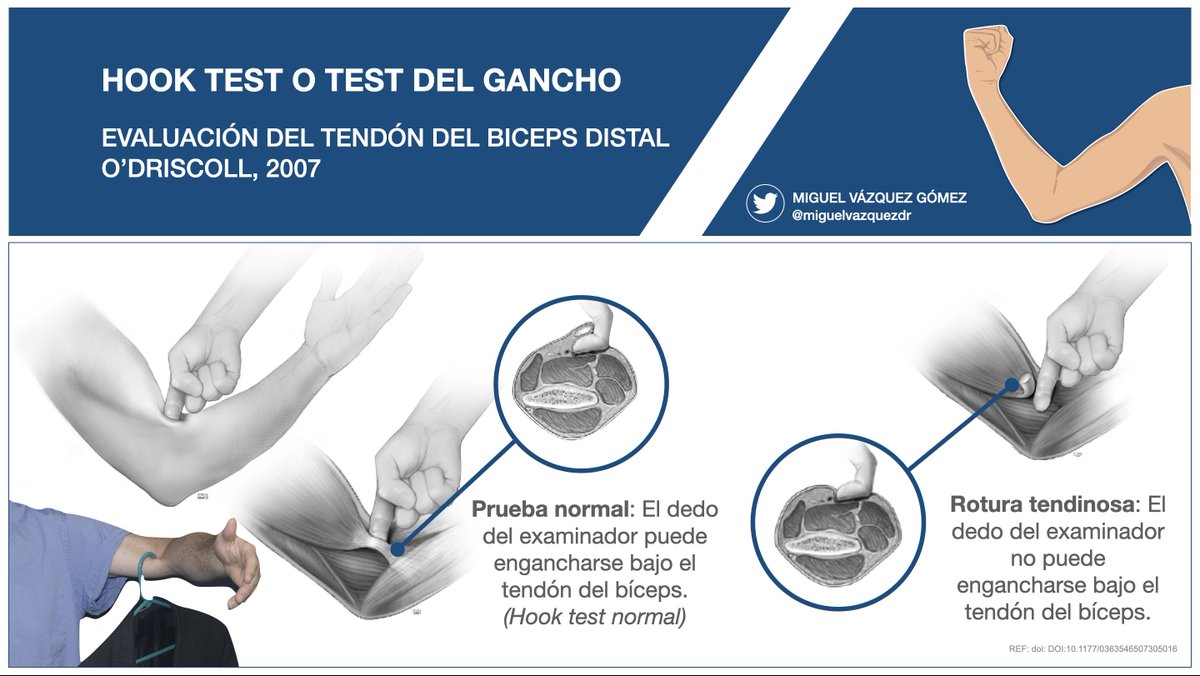 miguelvazquezdr's tweet photo. ⚠️ EVALUACIÓN DEL TENDÓN DEL BÍCEPS DISTAL ⚠️

✅ HOOK TEST: Palpación del tendón desde LATERAL con el codo en flexión de 90º y supinación máxima.
✅ Con el tendón intacto, el dedo puede introducirse 1 cm por debajo del tendón.
✅ S 100% y E 93% (O´Driscoll 2007) https://t.co/qlLjKZkPLV