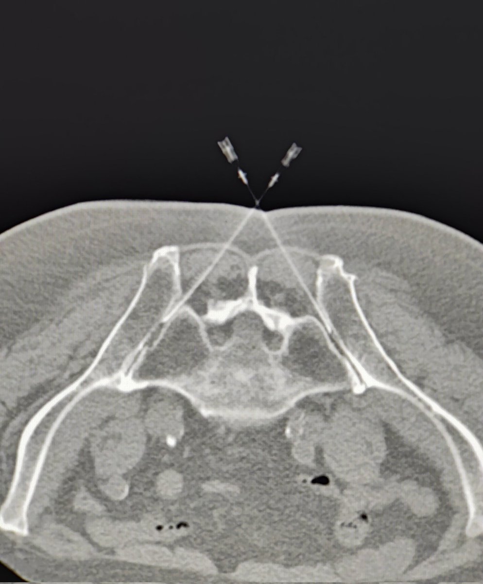 A satisfying start to the day 💉 #mskrad
#mskradiology