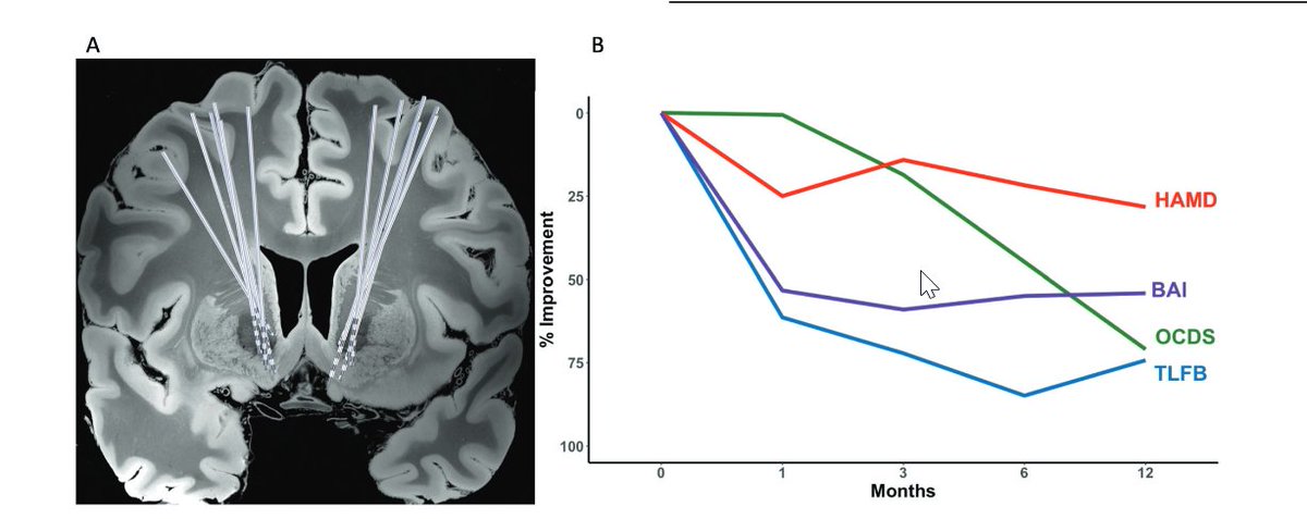 molecularpsychiatry (@molpsychiatry) on Twitter photo Deep brain stimulation of the nucleus accumbens in the treatment of severe alcohol use disorder: a phase I pilot trial. By Benjamin Davidson et al. <a href="/UofTNeuroSurge/">University of Toronto Neurosurgery</a> <a href="/Sunnybrook/">Sunnybrook Health Sciences Centre</a> #alcioholusedisorder #alcoholism #addiction #DBS #psychiatry #mentalhealth rdcu.be/cSy2n Deep brain stimulation of the nucleus accumbens in the treatment of severe alcohol use disorder: a phase I pilot trial. By Benjamin Davidson et al. <a href="/UofTNeuroSurge/">University of Toronto Neurosurgery</a> <a href="/Sunnybrook/">Sunnybrook Health Sciences Centre</a> #alcioholusedisorder #alcoholism #addiction #DBS #psychiatry #mentalhealth rdcu.be/cSy2n