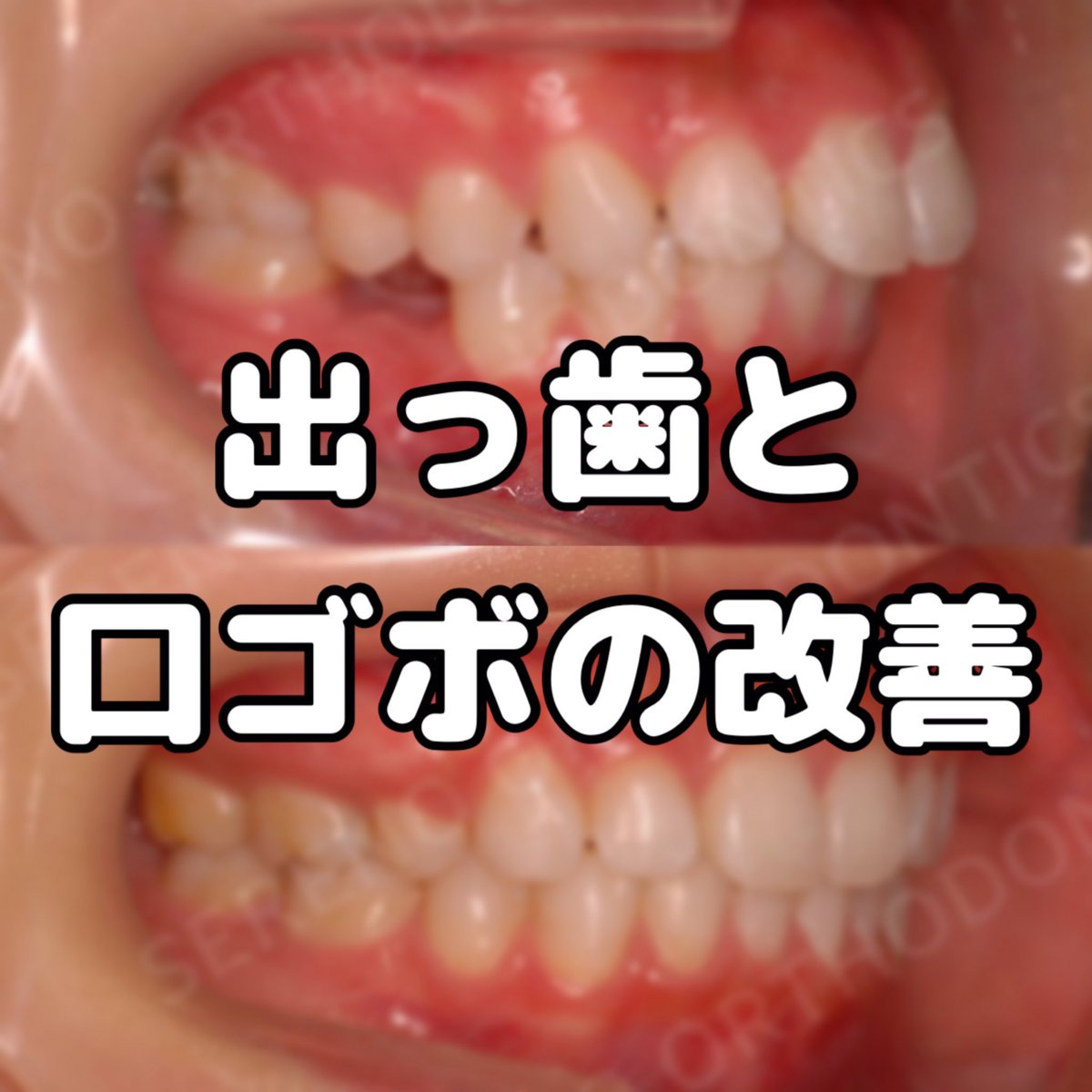 前歯を大幅に下げた事で口ゴボが改善しました 美しい笑顔です 口元の緊張もなくなりました セレーノ矯正歯科 歯列矯正 変化 裏側矯正 横顔 さいたま市 アンカースクリュー 口ゴボ 出っ歯 By 裏側矯正専門 大宮セレーノ矯正歯科 症例写真紹介 Edayfm 前歯を大幅に下げた事で口ゴボが改善しました 美しい笑顔です 口元の緊張もなくなりました セレーノ矯正歯科 歯列矯正 変化 裏側矯正 横顔 さいたま市 アンカースクリュー 口ゴボ 出っ歯 By 裏側矯正専門 大宮セレーノ矯正歯科 症例写真紹介 Edayfm