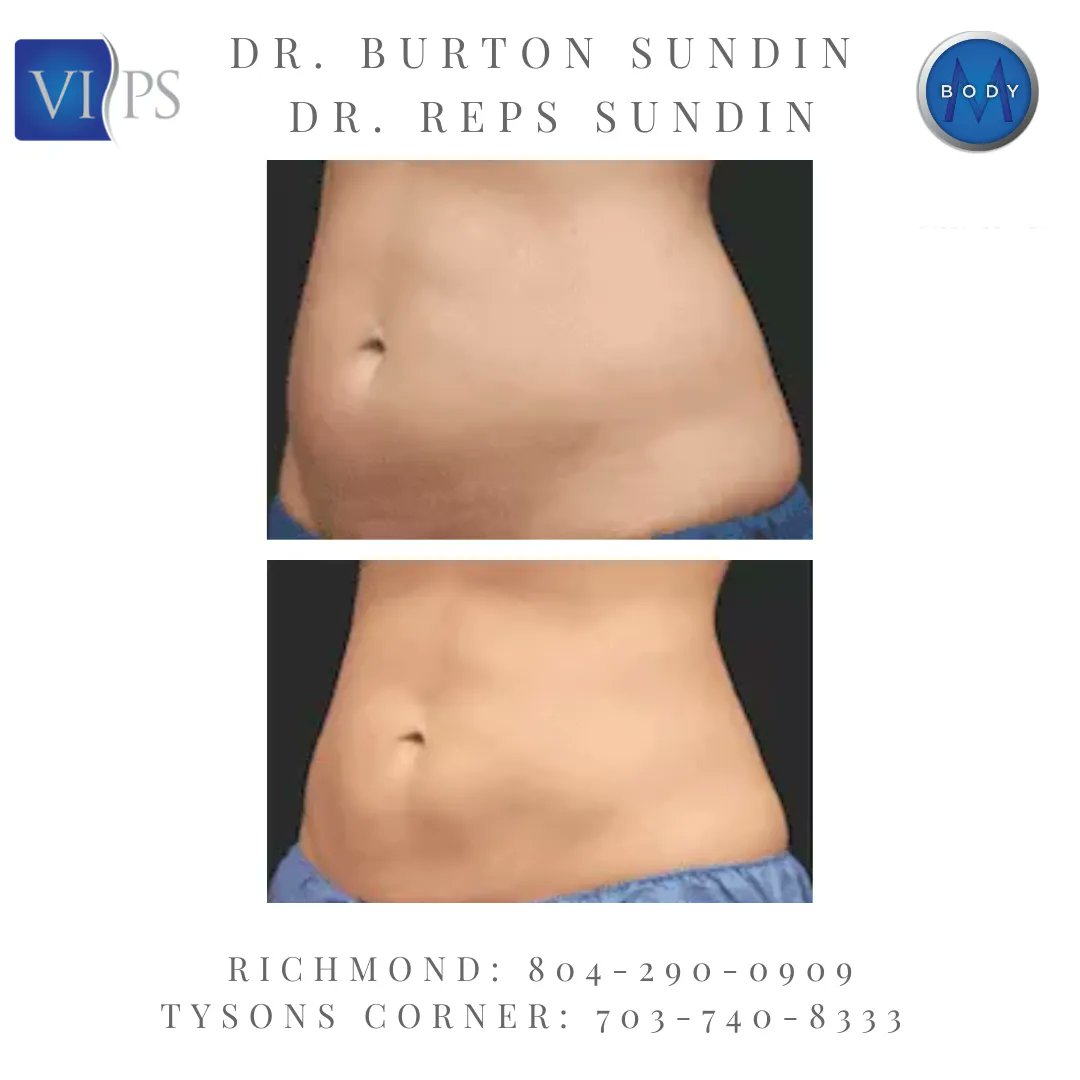 mbodycenter's tweet photo. CoolSculpting® offers a revolutionary new way to achieve a stunning, shapely physique!
Call today Tysons Corner (703) 740-8333 Richmond (804) 290-0909
#PlasticSurgery #MedSpa #Richmond #NorthernVirginia #VIPS #DrSundin #TysonsCorner #ViennaVA #WashingtonDC #coolsculpting #body https://t.co/pFlCyO2Def