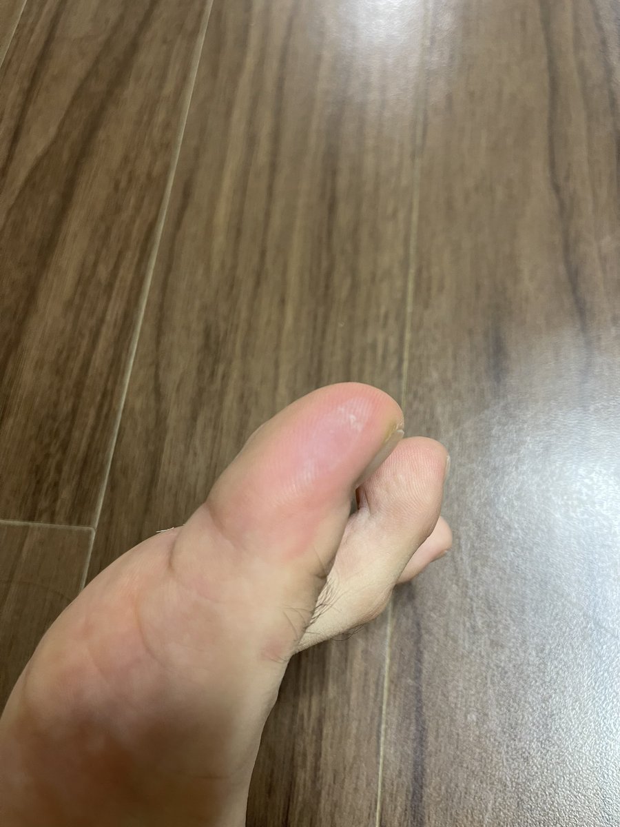 deokeyyy's tweet photo. [빨강이와 함께하는 트위터 6일차]
#SNKRZ #SNKRZCREW

요새 비가 많이와 발이 모두 젖은 상태로 운동을 했더니 너무 큰 물집이 잡혔다🥹
참고 운동해보았는��� 너무 아파서 도저히 못하고 실패.. 오늘 연고바르고 해서 내일은 오래 운동하고 싶다!

스니커즈 후기 블로그 : https://t.co/glpwa8un3a https://t.co/syn1RNuLBI