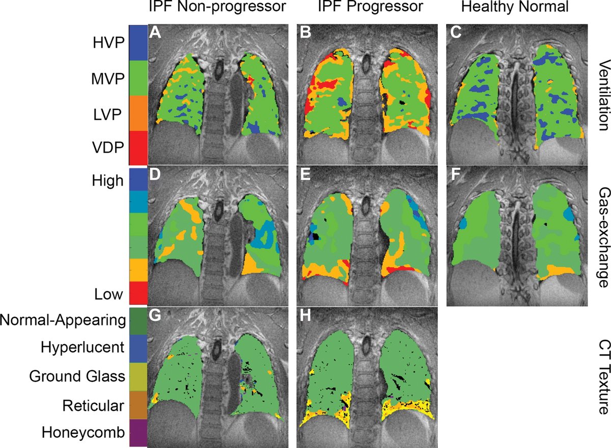 Radiology on Twitter "What does 129Xe MRI offer above and beyond