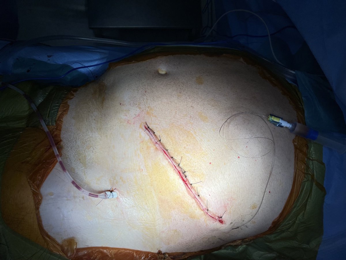 XavierBerardMD's tweet photo. Left 11th rib retroperitoneal approach for juxtarenal AAA. Basic 5 blades setup using OneFrame + extension sidebar @ThompsonSurg #aortaEd https://t.co/cWdNomHUTA