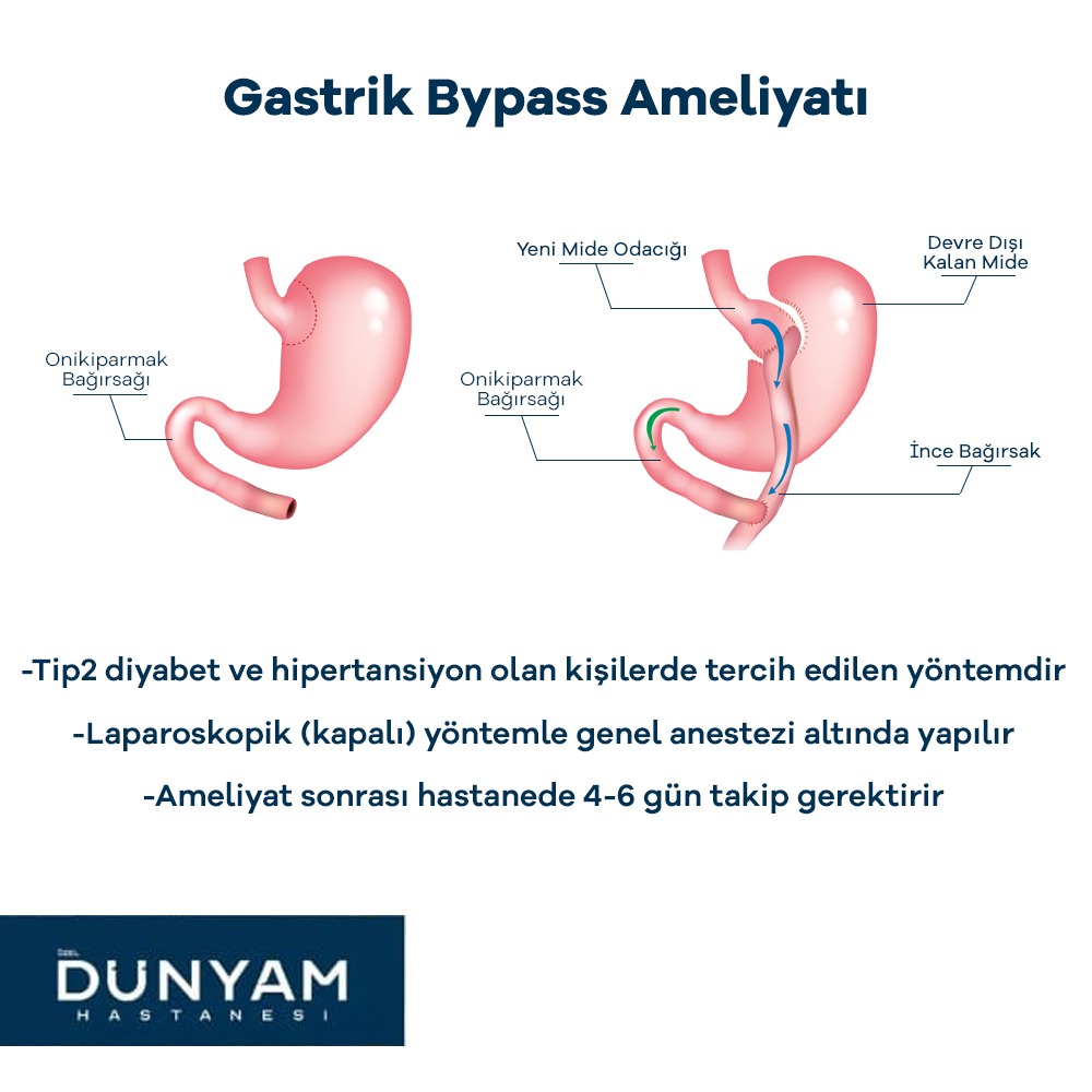 Op. Dr. Mehmet Ali Deneme ile Tüp mide &amp; Gastrik Bypass ameliyatıyla ideal kilonuza kavuşun.

✔ Detaylı bilgi ve randevu almak için bizimle iletişime geçebilirsiniz.

🌐 dunyamhastanesi.com
📞 0 (352) 207 77 77
📲 0 (505) 003 15 00"
#tüpmide #gastrik #bypass #dünyamhastanesi
