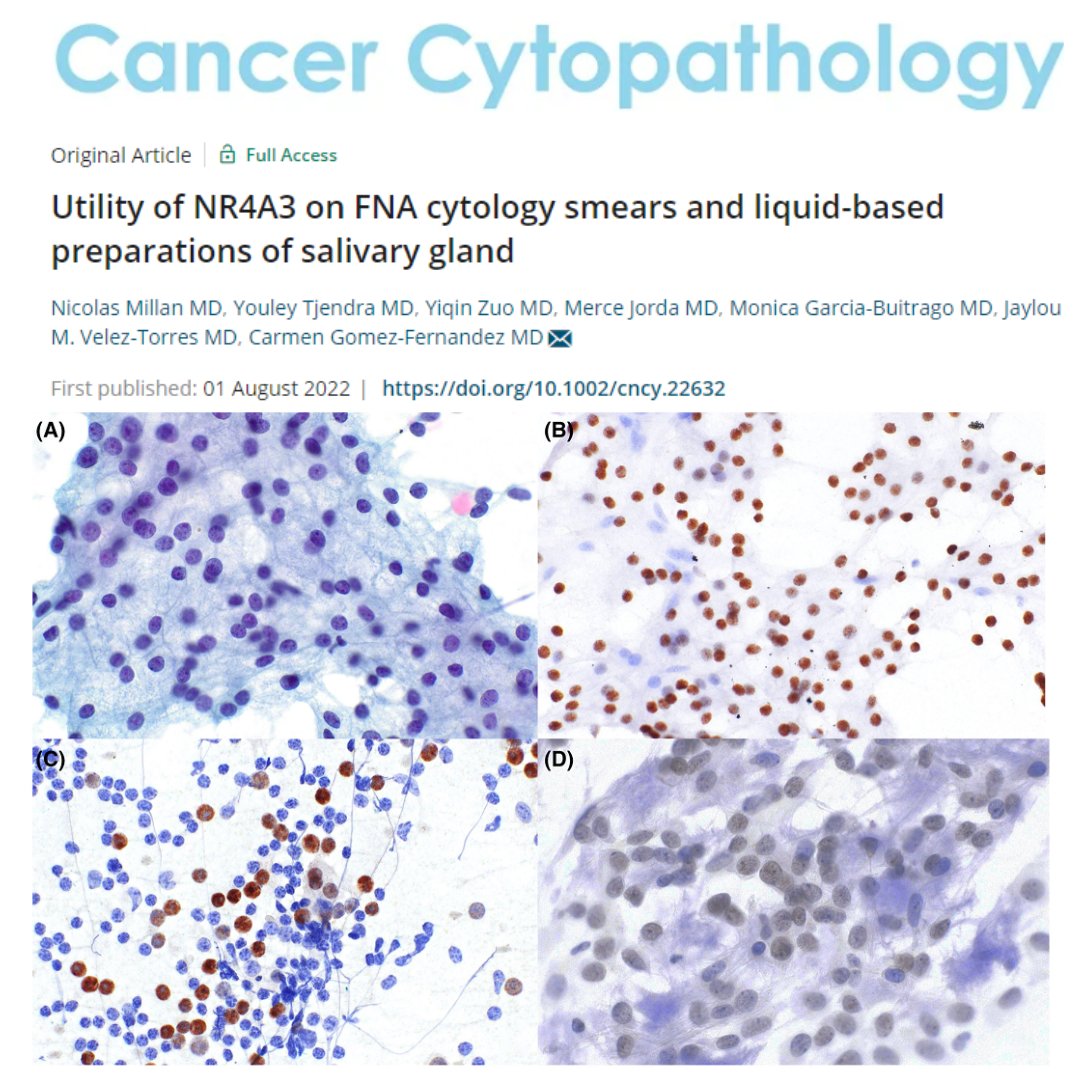 NR4A3 immunocytochemistry can be used directly on FNAC conventional smears &amp; liquid-based cytology to reliably distinguish acinic cell carcinoma from its mimickers. This may be useful in cases where a cell block preparation is unavailable or inadequate. acsjournals.onlinelibrary.wiley.com/doi/full/10.10…